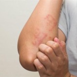 تشققات الجلد سبب محتمل لحساسية الطعام.. علماء يكشفون