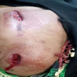 إصابة إمرأة برصاصة قناص حوثي بالضالع