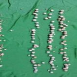 فريق طبي في شبوة ينجح في إزالة 193 حصوة بولية بمنظار طبي دقيق