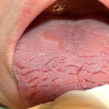 6 حالات صحية يخبرك “اللسان الصدفي” عن جسمك