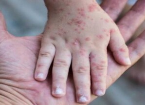 تصاعد إصابات ووفيات الحصبة في المحافظات المحررة خلال أبريل